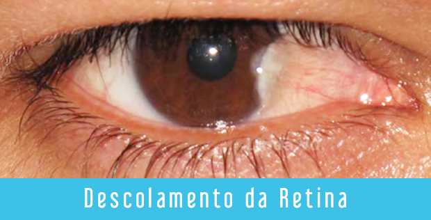 Descolamento da Retina  Oculari Hospital Oftalmológico